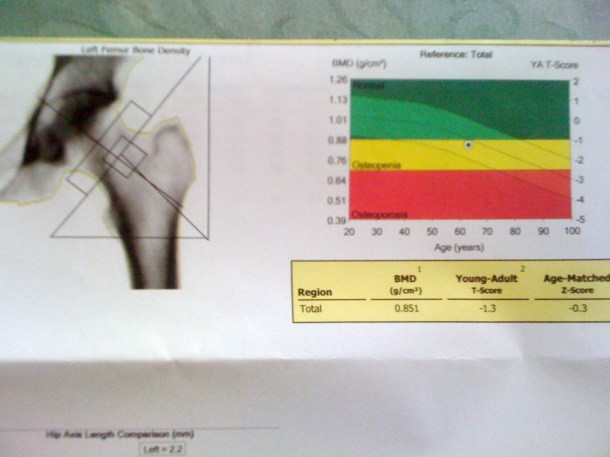 bone density scan result 001